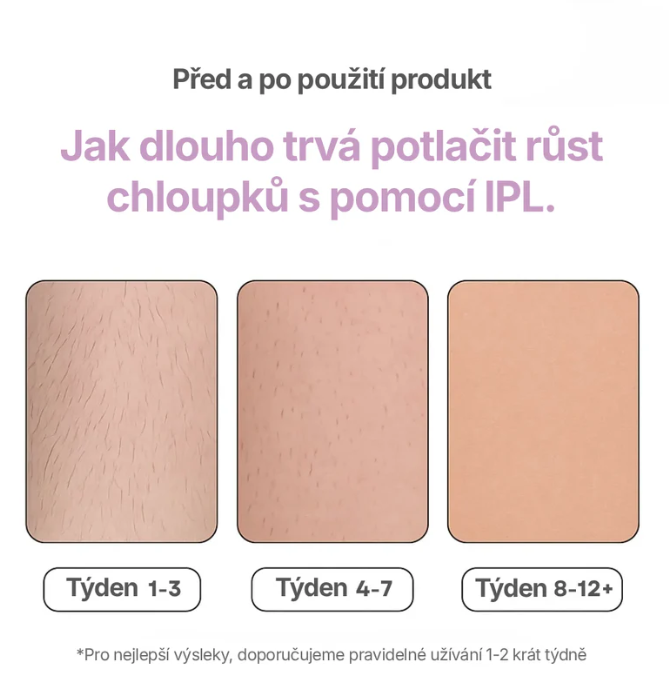 VELERA: IPL Laserový Odstraňovač Chloupků